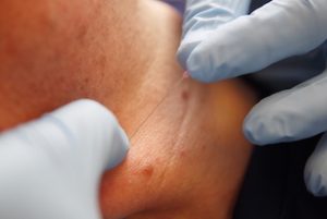 dry needling Praktijk de Wiel